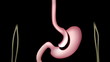 Mini gastric bypass surgery