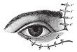 Fig. 178. Blepharoplasty by the method of Blasius, vintage engra