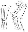 Kneecap or Patella, vintage engraving.