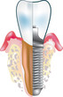 Tooth implant