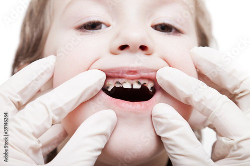 Photo: Examining caries teeth decay Examining caries teeth decay