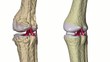 Osteoarthritis : Knee joint with ligaments and cartilages