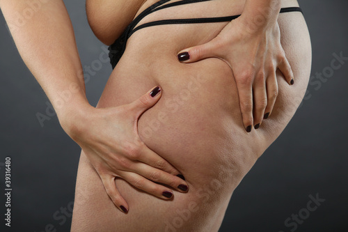Photo: Cellulite - bad skin condition Cellulite - bad skin condition