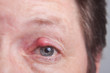 Auge mit Gerstenkorn