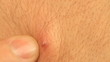 Pimple Extreme Macro