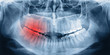 Foto: X-ray scan of teeth X-ray scan of teeth