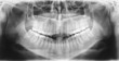 Foto: X-ray scan of teeth X-ray scan of teeth