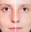 Woman with spotty skin with deep pores and healed soft skin