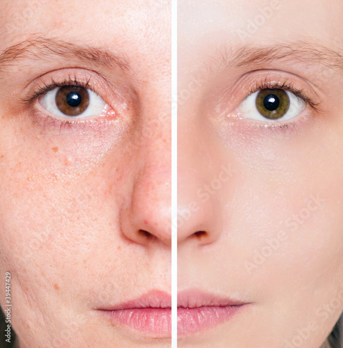 Photo: Woman with spotty skin with deep pores and healed soft skin Woman with spotty skin with deep pores and healed soft skin