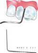 periodontal probe