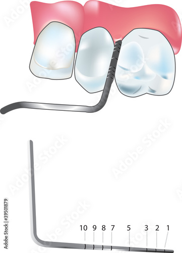 Vector: periodontal probe periodontal probe