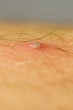 Pimple Extreme Macro