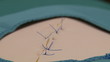 Surgeon exercising stitches removal