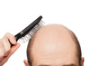 Photo: Bald man head Bald man head