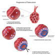 Progression of pulmonary tuberculosis, eps8