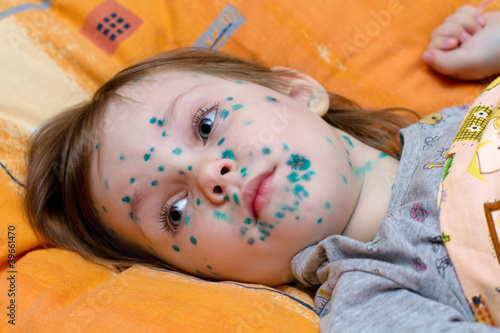 Photo: The girl suffers chickenpox The girl suffers chickenpox