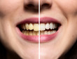 Clean Teeth
