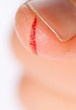 injured finger