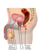 prostata