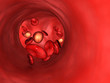 cyst
