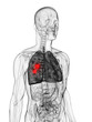 3d rendered scientific illustration of a lung tumor 3d rendered scientific illustration of a lung tumor