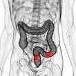3d rendered scientific illustration of a colon tumor
