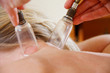 Schröpfmassage bei Nackenproblemen