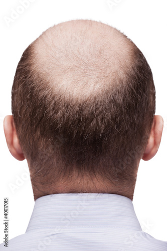 Photo: Bald man head Bald man head