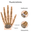 Base of thumb arthritis, eps8