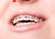 Photo: Beautiful young woman with brackets on teeth Beautiful young woman with brackets on teeth