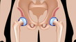 Osteoarthritis of hip joint