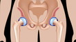 Rheumatoid arthritis of hip joint
