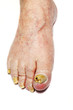 Fungal Nail Infection