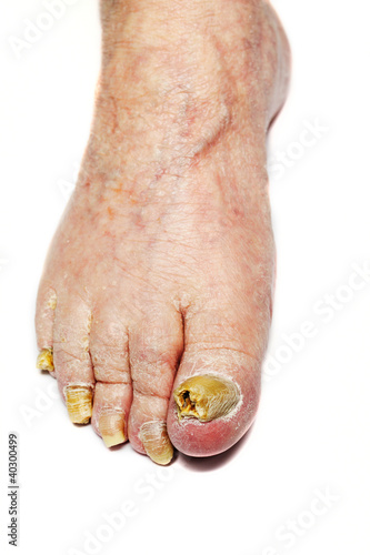 Photo: Fungal Nail Infection Fungal Nail Infection