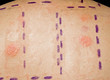 Photo: Skin Allergy Patch Test Showing Positive Reaction Skin Allergy Patch Test Showing Positive Reaction