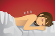 Acupuncture treatment