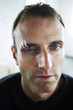 Man with swollen eye