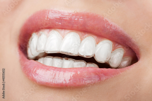 Photo: teeth with whitening tray teeth with whitening tray