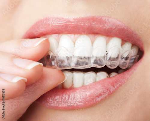 Photo: teeth with whitening tray teeth with whitening tray