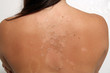 Photo: Sunburned, Peeling Female (3) Sunburned, Peeling Female (3)