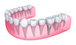 Dental implant in the gum - Isolated on white