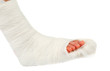 leg in a plaster cast