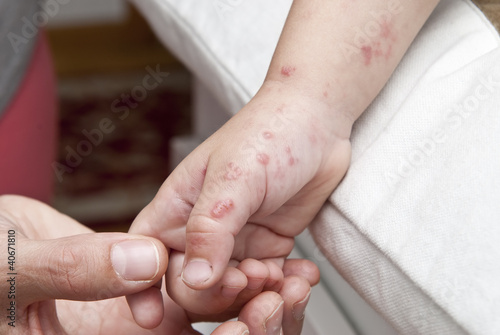Photo: Herpes zoster en la mano de un niño pequeño. Herpes zoster en la mano de un niño pequeño.