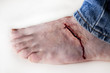 Photo: Foor Laceration Foor Laceration