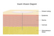 Diagram illustrating insulin infusion through an infusion set