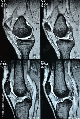 Foto: Röntgenbild Knie Details Röntgenbild Knie Details