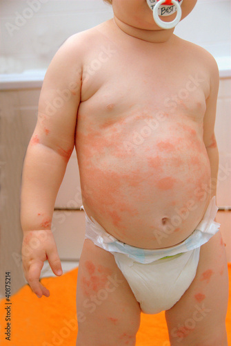 Photo: Child with neurodermitis Child with neurodermitis