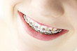 Smile with braces