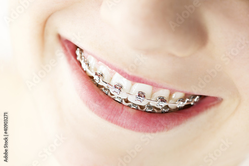 Photo: Smile with braces Smile with braces