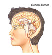 Gehirntumor.Weibliches Gehirn Gehirntumor.Weibliches Gehirn